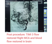 Medical Miracle at Bankers Group, Mechanical Thrombectomy was Done for Brain stroke